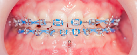 Bandes Matricielles Métalliques Dentaires + Coins De Diastème - Pour Laboratoire Dentaire, Pose De Résine Et Séparation
