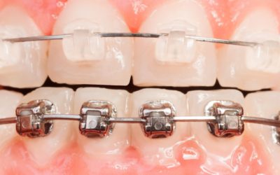 Orthodontiste à Propriano : Tarifs et remboursements