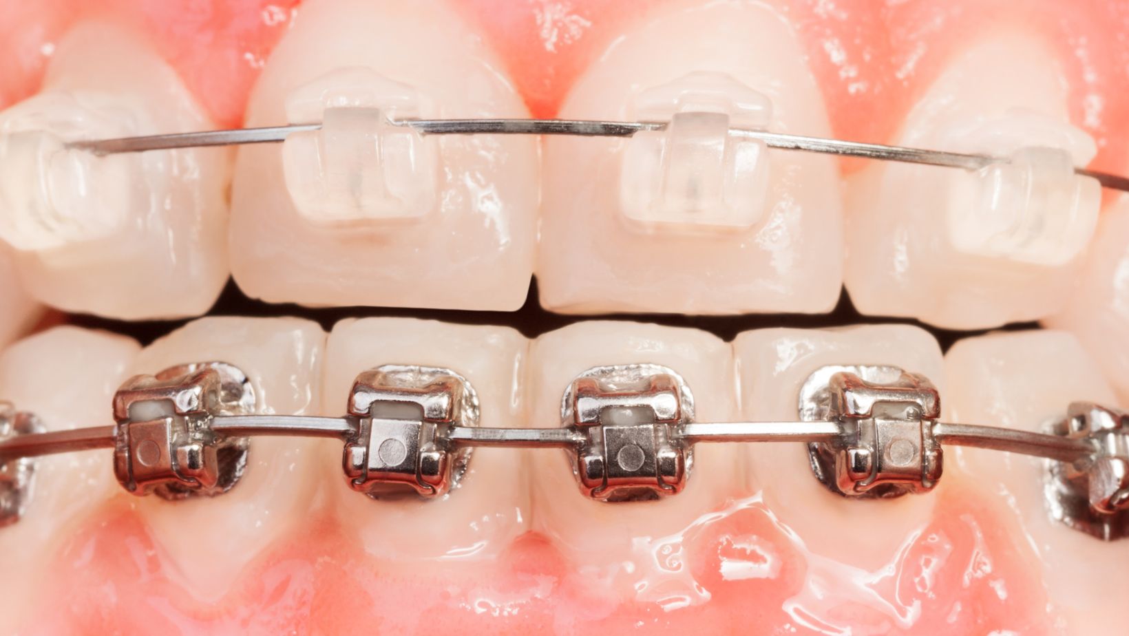 Modèle De Dent Avec Des Bagues Dentaires De Fil En Métal Photo stock -  Image du santé, dentisterie: 128694922