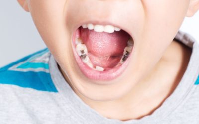 La carie dentaire chez l’enfant : Comprendre