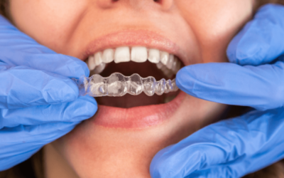 Urgences orthodontiques : Comment réagir aux situations d’urgence avec des aligneurs orthodontiques ?